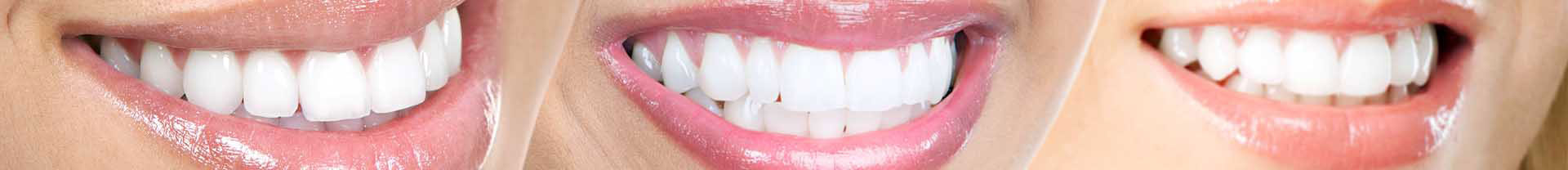 The image shows a close-up of three different smiles with varying levels of teeth whiteness, presented against a neutral background.