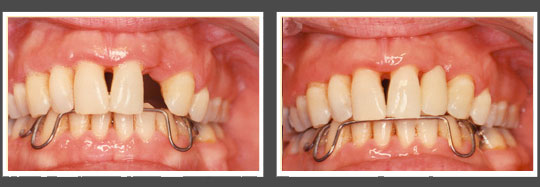 The image shows a before-and-after comparison of teeth with visible dental implants, highlighting the transformation from an uncorrected state to a corrected one.