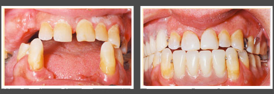 The image displays two photographs side by side, showing a person s teeth before and after dental treatment, with the bottom photo illustrating a significant improvement in the appearance of the teeth through cosmetic dentistry.