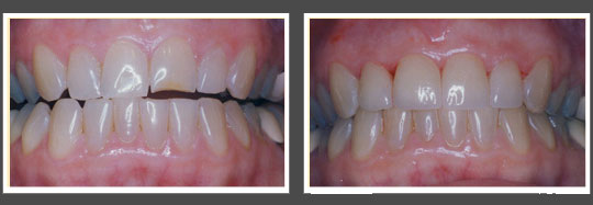 The image shows two photos side by side of a person s teeth before and after dental treatment, likely showcasing a transformation from discolored or damaged teeth to a cleaner, more even appearance.