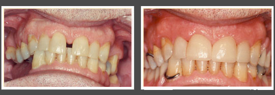 The image shows two photographs side by side of an individual s teeth before and after dental treatment, highlighting a transformation from discolored to clean and aligned teeth.