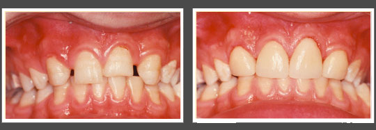 The image shows two photographs of teeth with pink gums placed side by side against a gray background.