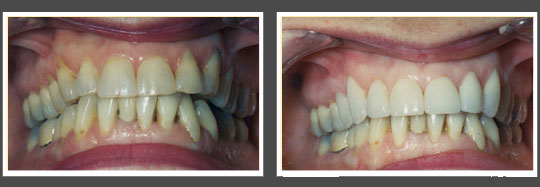 The image displays two photographs side by side of a person s teeth before and after dental treatment, showcasing the transformation from yellowed teeth to clean, white teeth.