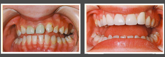 The image displays two photographs side by side of a person s teeth before and after dental treatment, highlighting the transformation from yellowed teeth to clean, white teeth.