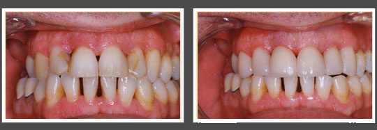 The image shows two side-by-side photographs of a person s mouth with a close-up view of teeth undergoing dental treatment, highlighting the transformation from discolored to clean teeth.