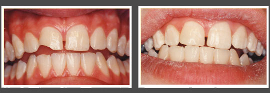 The image shows two side-by-side photographs of a person s teeth before and after dental treatment, highlighting the transformation achieved through orthodontic care.
