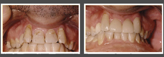 The image shows two side-by-side photographs of a person s mouth with teeth before and after dental treatment, highlighting the transformation from yellowed and gapped teeth to a cleaner and more even smile.