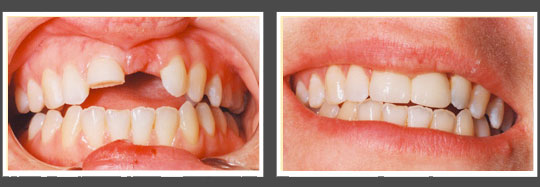 The image shows two photographs side by side of a person s teeth before and after dental treatment, highlighting the transformation from an unhealthy smile with missing teeth to a healthy one with a full set of teeth.
