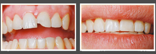 The image shows two photographs side by side of a person s teeth before and after treatment, highlighting the difference between their original condition and the result of dental care.