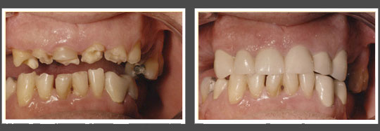 The image shows two photos side by side of a person s mouth with teeth before and after dental treatment, highlighting the transformation from yellowed to whiter teeth.