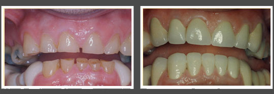 The image displays two photographs side by side, showing a close-up view of a person s teeth with a significant difference in coloration between them. On the left, the teeth appear yellowed, while on the right, they are clean and white after dental treatment.