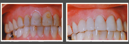The image shows a pair of photographs side by side, featuring a close-up view of a person s teeth with a focus on dental hygiene, likely before and after treatment or care.