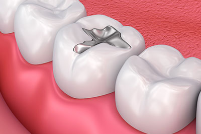 The image shows a dental implant in the process of being inserted into a prepared tooth socket.