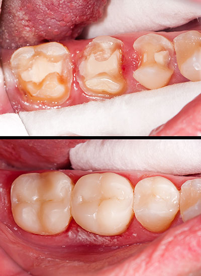 The image displays a close-up view of a person s oral cavity with an open mouth, showcasing teeth with significant decay, discoloration, and damage, including missing enamel and exposed dentin, against a backdrop of a tongue and partial palate.