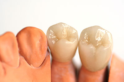 The image shows a set of upper dentures with teeth and gums displayed side by side.