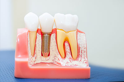 The image shows a dental model with four teeth, each with a hole or cavity, positioned on a pink base resembling gums, with a screw visible at the bottom, likely for securing the model in place.
