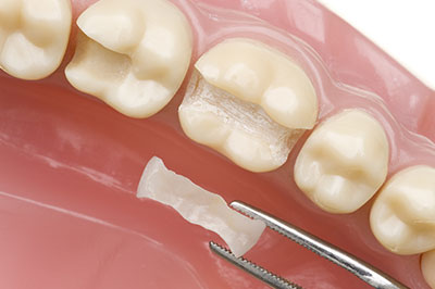 The image shows a dental implant being placed into an artificial tooth socket within a human-like dental model, with a metal surgical tool nearby.