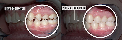 The image is a composite of two photographs side by side, showing a person s teeth with an overlay of text indicating  MALOCCLUSION  and a magnified view of the same teeth labeled  NORMAL OCCLUSION.