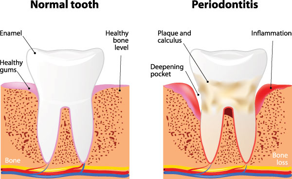 The image displays a diagrammatic representation of the progression of tooth decay from normal to periodontitis, illustrating the stages with labeled images of teeth at different levels of decay, including enamel loss and bone exposure, accompanied by annotations explaining each stage.