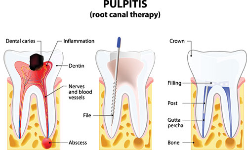 The image shows a medical illustration with annotations explaining the structure of a tooth, including roots, dental caries, inflammation, and a crown with a filling. It also depicts a cross-sectional view of a tooth s interior, highlighting the root canal system, dentin, and pulpitis.