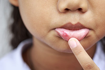 A child with acne on their face, using their finger to touch the affected area.