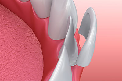 The image shows a close-up view of a dental implant with a screw visible on its surface, set against a background with a hint of pink tissue, possibly a gum line.