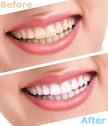 The image shows a before-and-after comparison of dental whitening treatment, with two photos side by side  one showing a person s teeth before the treatment, and the other after, highlighting the significant improvement in tooth color and brightness.
