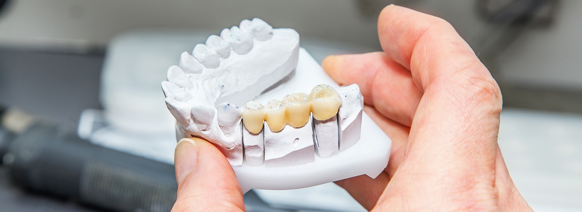 The image shows a person holding a dental implant with multiple teeth attached, set against a blurred background.