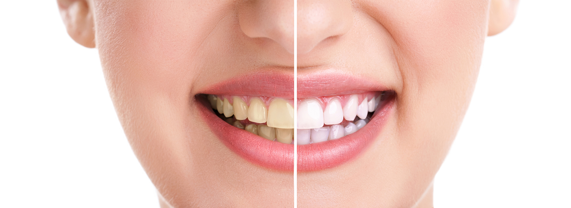 Alt text  A close-up photograph of a smiling person with teeth whitening product before and after application, highlighting the transformation.